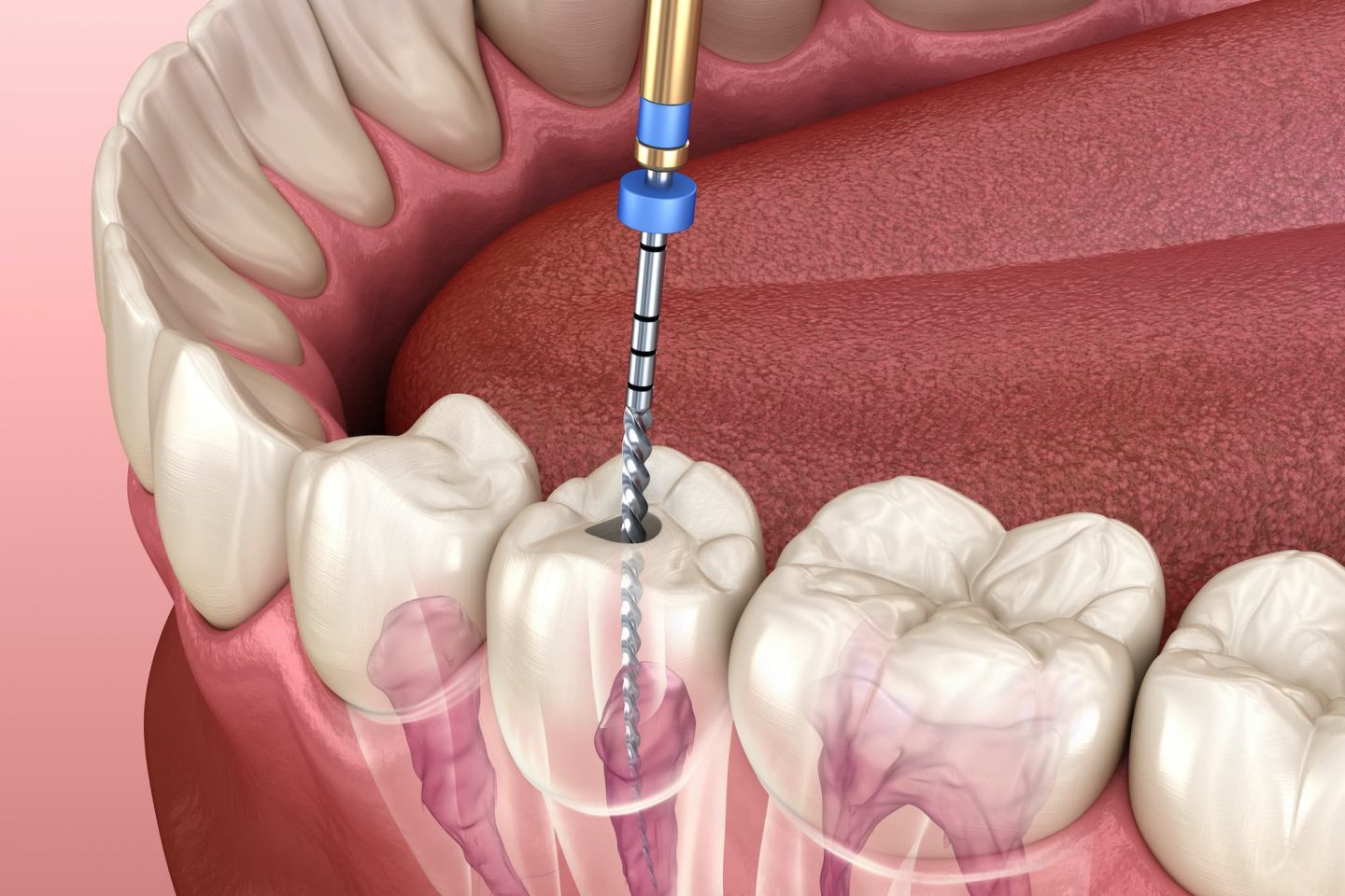 root_canal_treatment